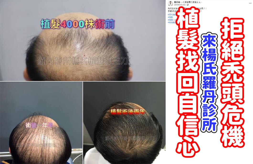 【植髮】拒絕禿頭危機，來楊氏羅丹診所植髮找回自信心！