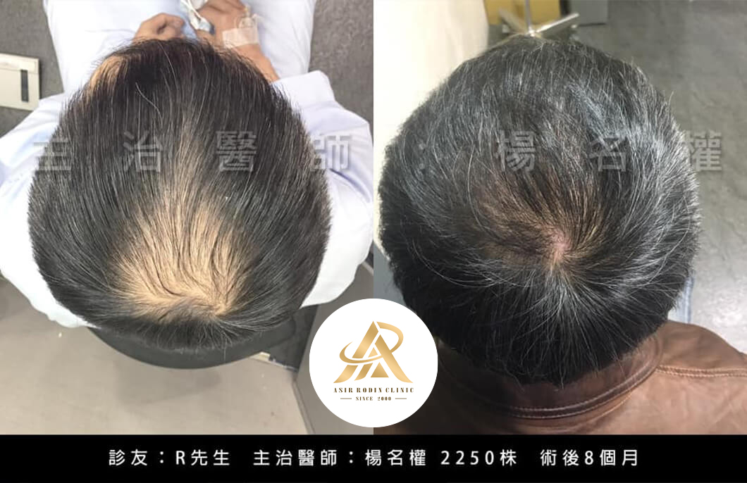 【植髮】找回頂上自信，植髮輕鬆挽救禿髮讓你再次茂密