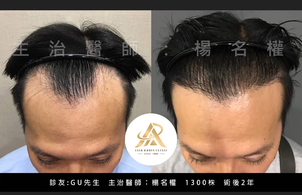 【植髮】美型植髮拯救禿髮，別再當被髮際線耽誤的男人！