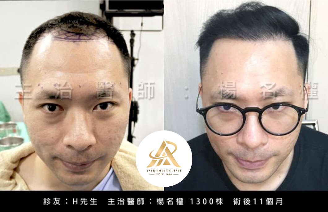 【植髮】打造完美髮際線，植髮手術讓你回歸年輕有型！
