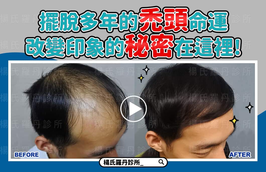 【植髮】擺脫多年的禿頭命運，改變印象的秘密在這裡!