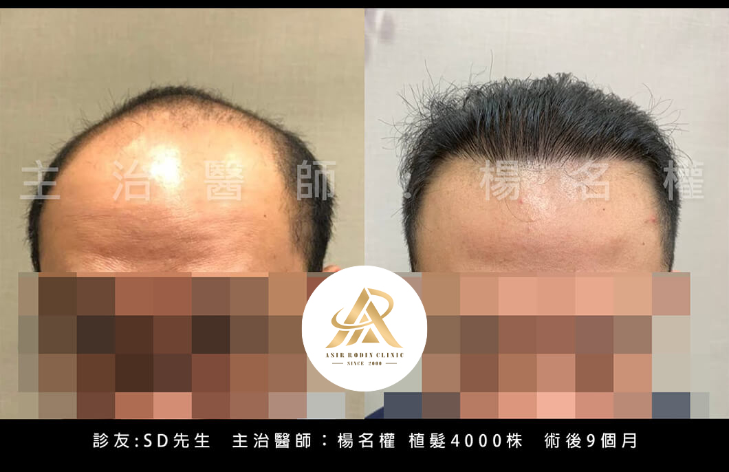 【植髮】植髮術後再年輕一次，改寫禿頭命運阿北變帥哥
