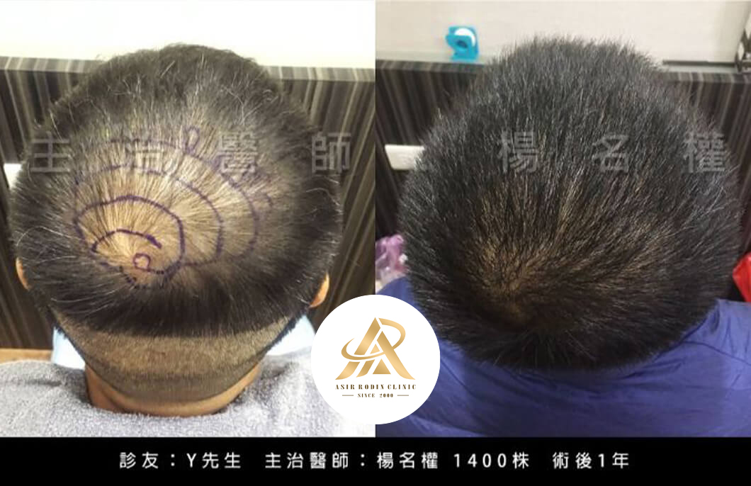 【植髮】植髮還你茂密髮量，輕鬆解決地中海禿頭困擾！