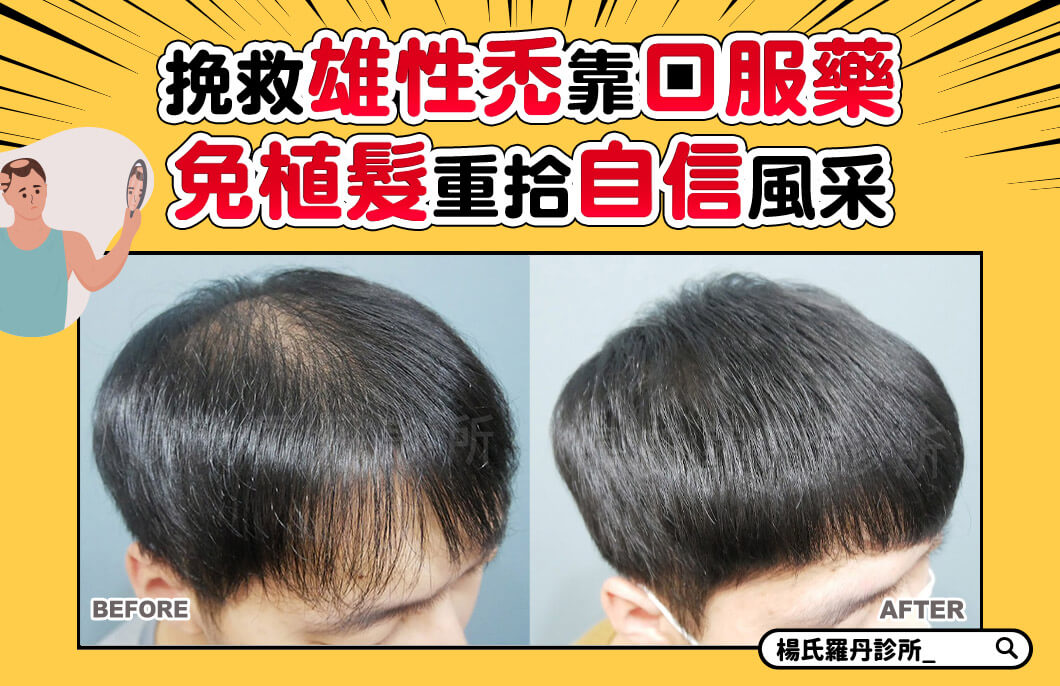 【複合式生髮】挽救雄性禿靠口服藥，免植髮重拾自信風采