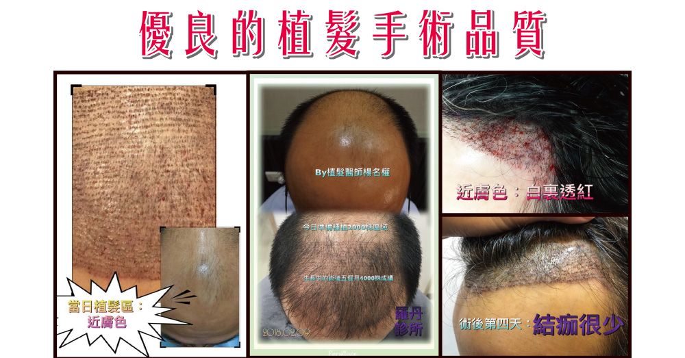【植髮】成功關鍵：高密度與高存活率