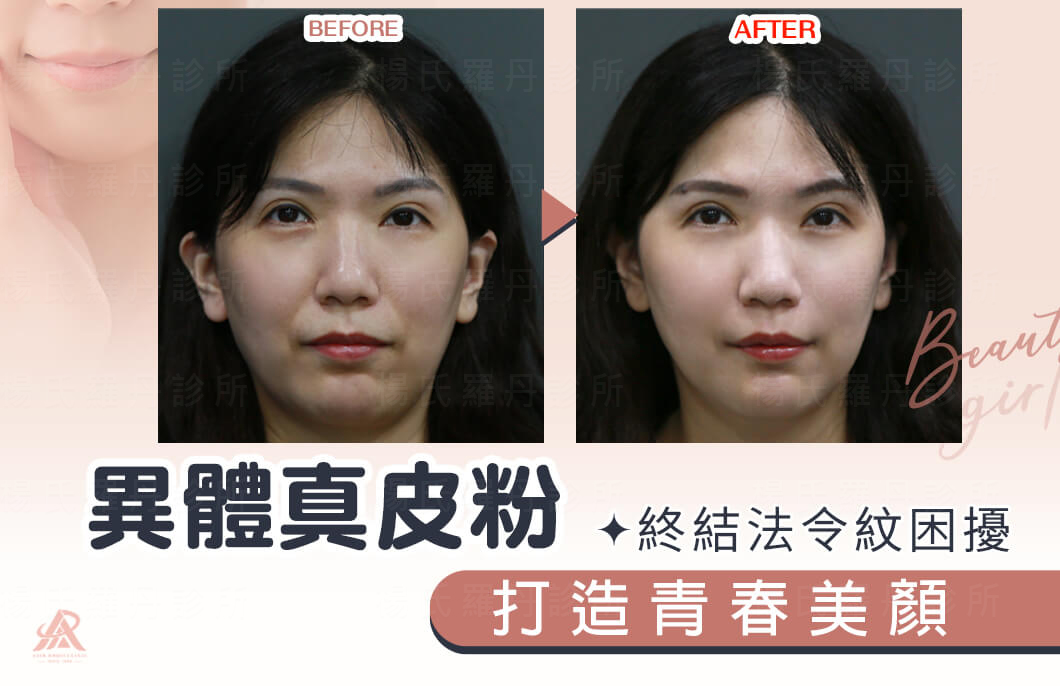 【醫美療程】異體真皮粉打造青春美顏，終結法令紋困擾