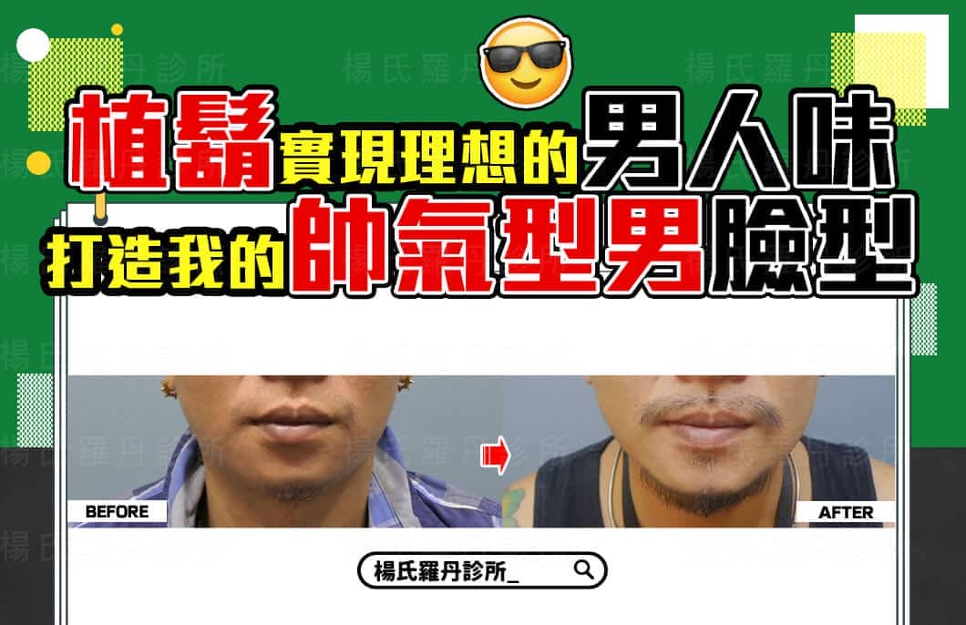 【植髮】植鬍實現理想的男人味，打造我的帥氣型男臉型
