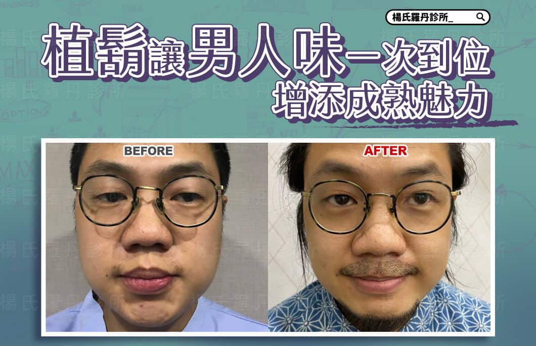 【植髮】植鬍讓男人味一次到位，增添有個性的成熟魅力