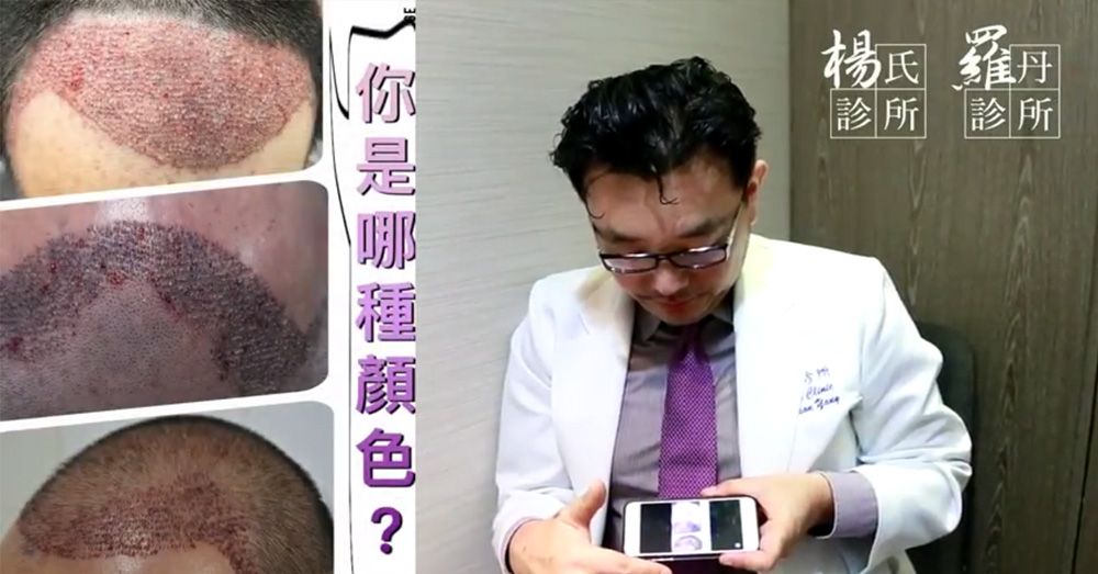 【植髮】怎樣才算成功？高密度、高存活率是關鍵