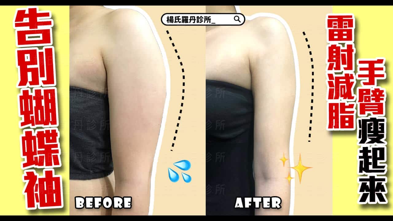 【雷射減脂】告別蝴蝶袖和副乳，雷射減脂瘦手臂瘦起來
