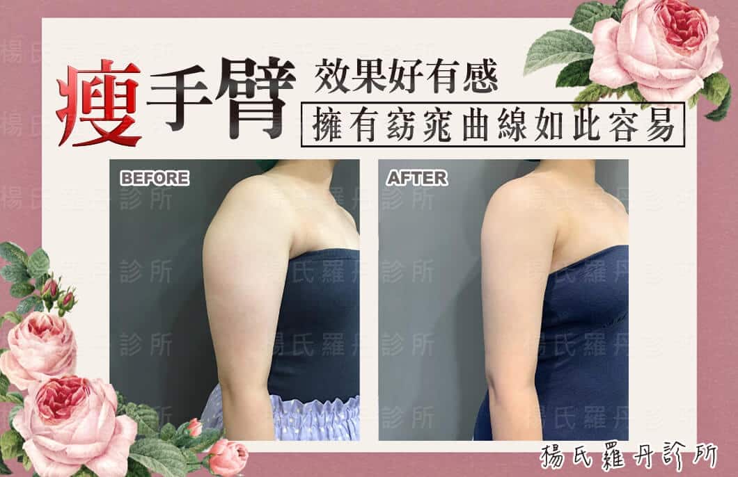 【雷射減脂】瘦手臂效果好有感，擁有窈窕曲線如此容易