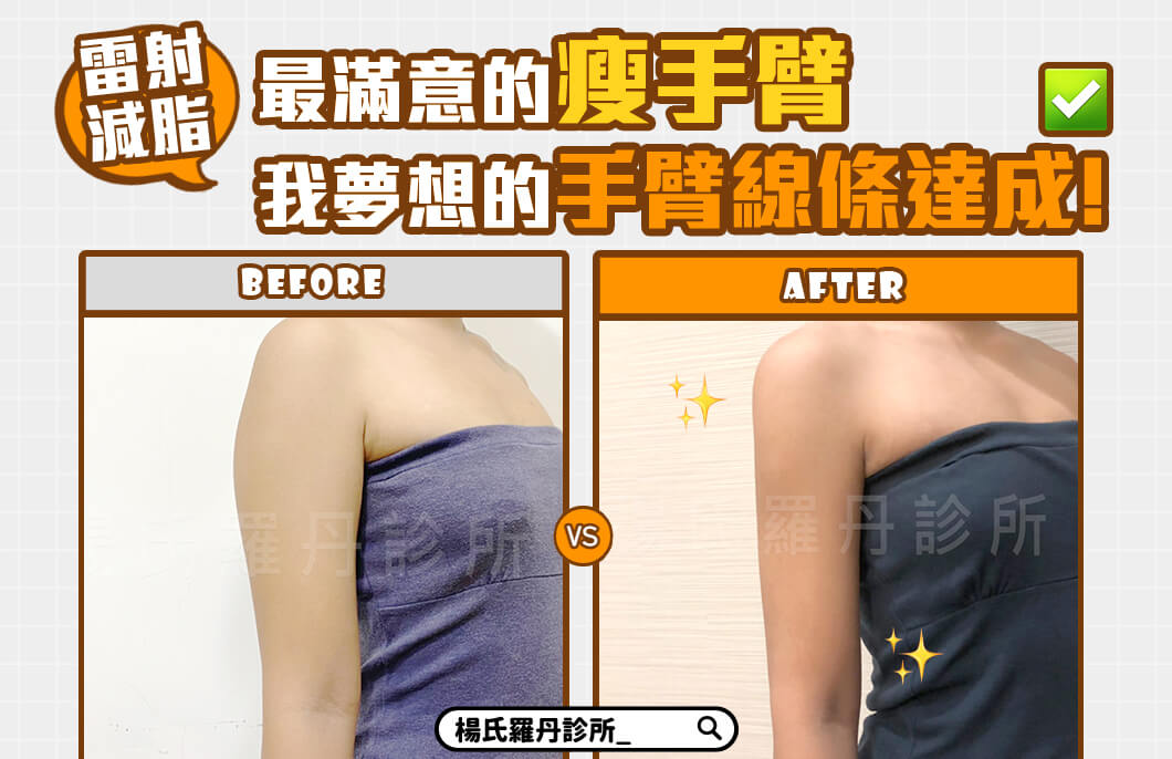 【雷射減脂】最滿意的瘦手臂，我夢想的手臂線條達成!