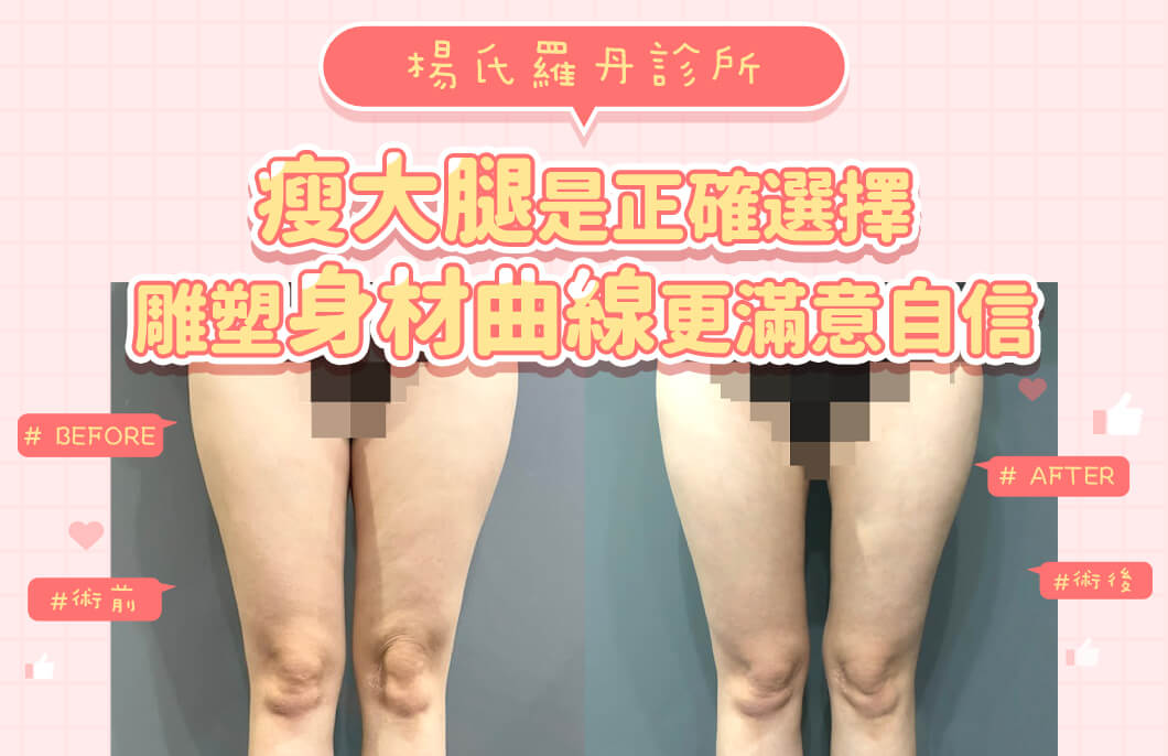 【雷射減脂】瘦大腿是正確選擇，雕塑身材曲線更滿意自信