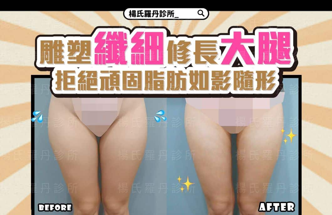 【雷射減脂】雕塑纖細修長大腿，拒絕頑固脂肪如影隨形