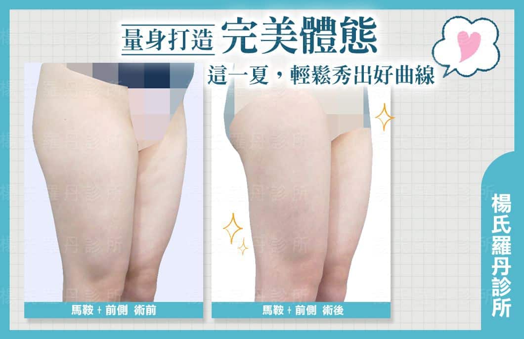 【雷射減脂】量身打造完美體態，這一夏輕鬆秀出好曲線