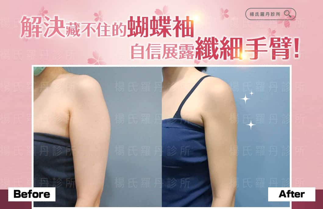 【雷射減脂】解決藏不住的蝴蝶袖，自信展露纖細手臂！