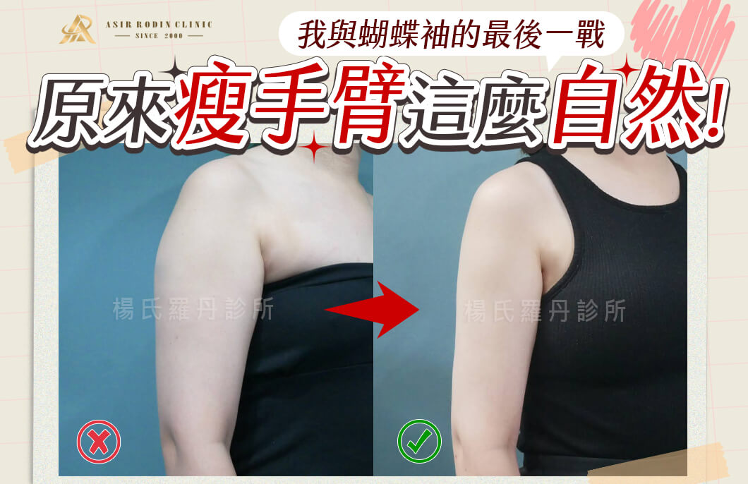 【雷射減脂】原來瘦手臂這麼自然！我與蝴蝶袖的最後一戰