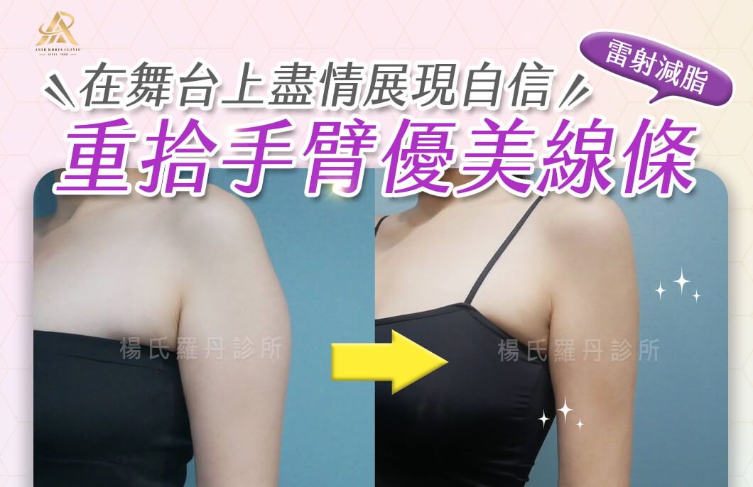 【雷射減脂】重拾手臂優美線條，在舞台上盡情展現自信