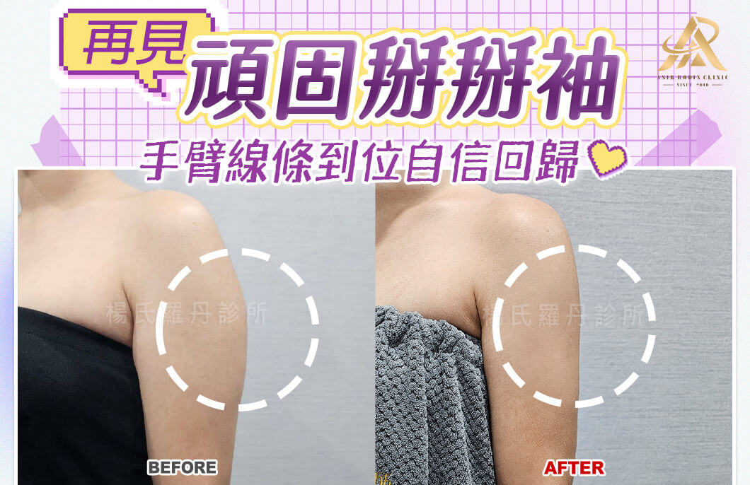 【雷射減脂】再見頑固掰掰袖，手臂線條到位自信回歸！