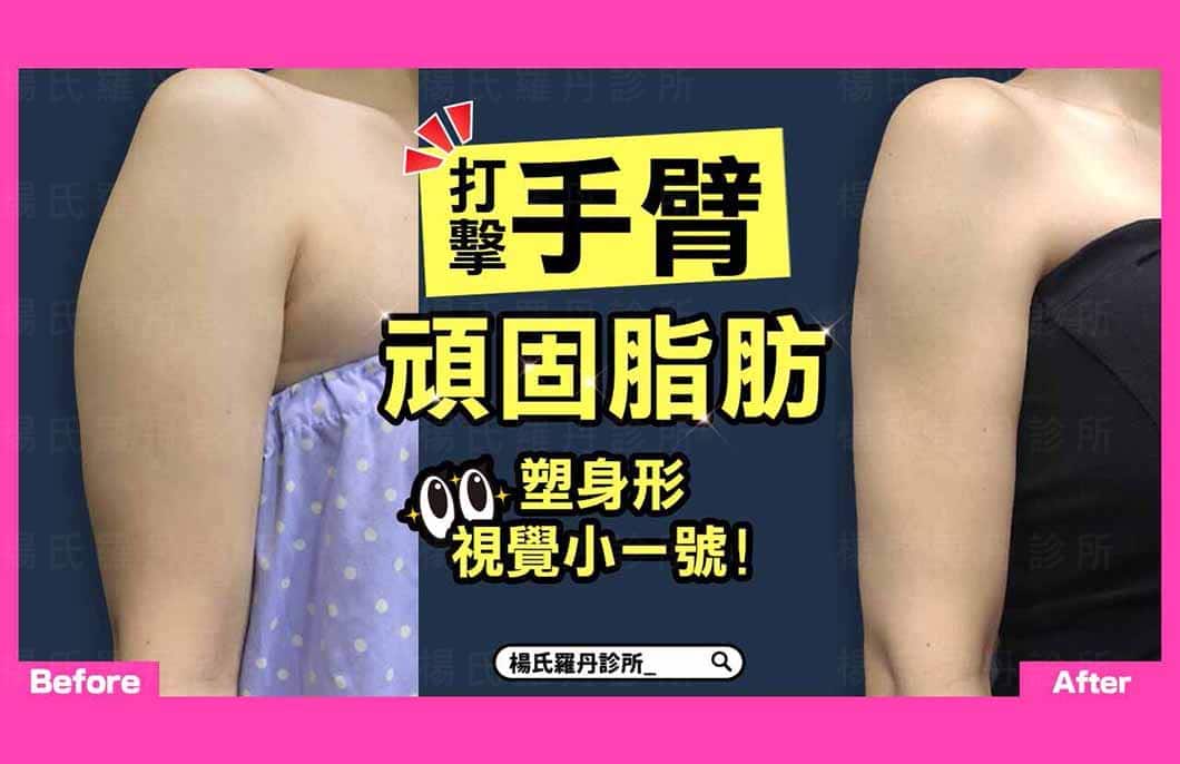 【雷射減脂】打擊手臂頑固脂肪，雕塑身形視覺效果小一號