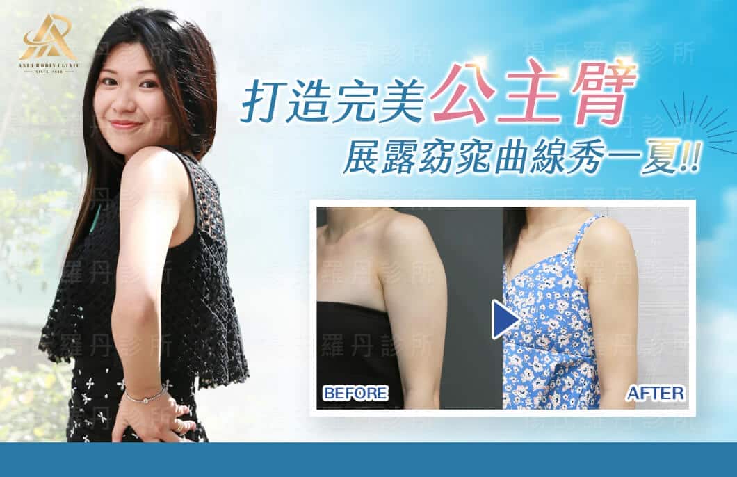 【雷射減脂】打造完美公主臂，展露窈窕曲線秀一夏！！