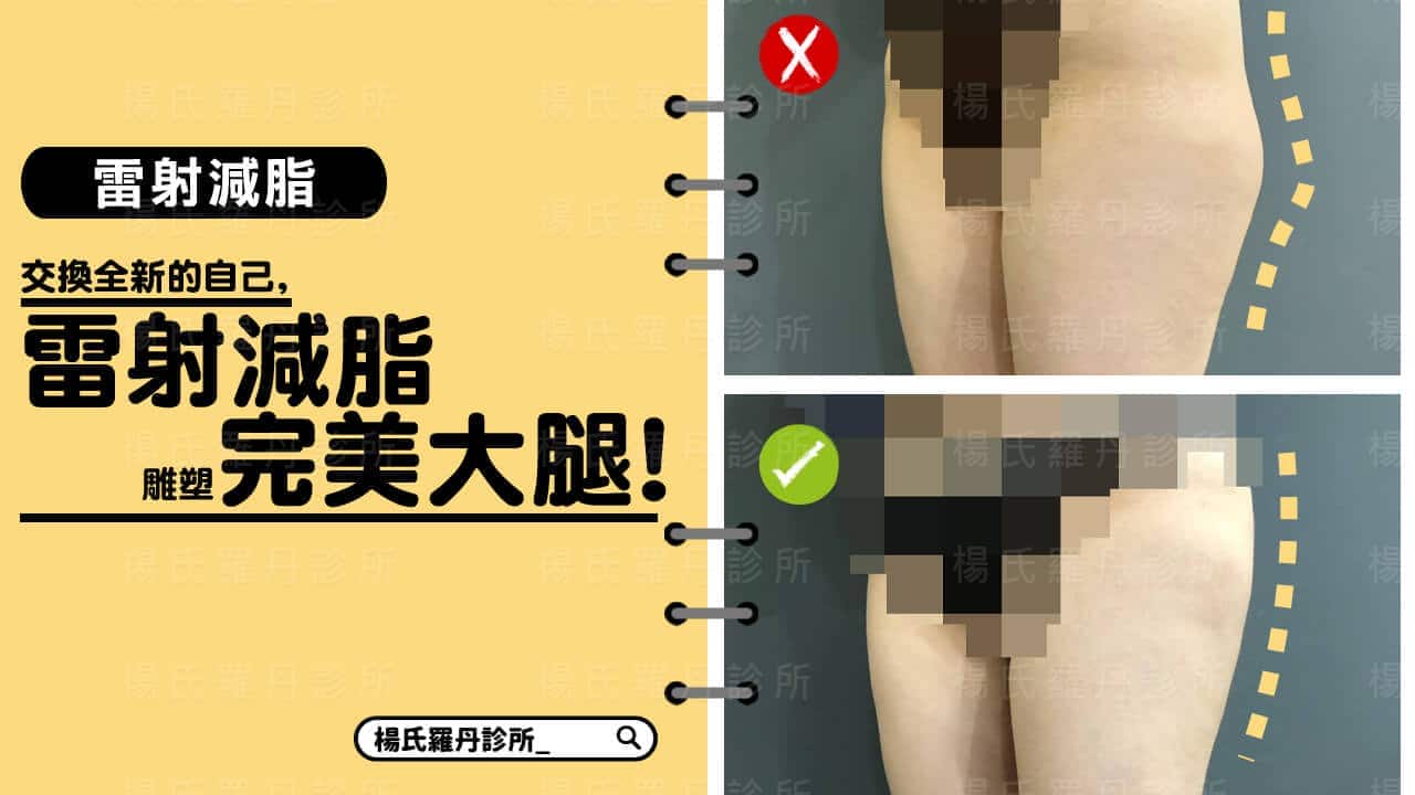 【雷射減脂】交換全新的自己，雷射減脂雕塑完美大腿！