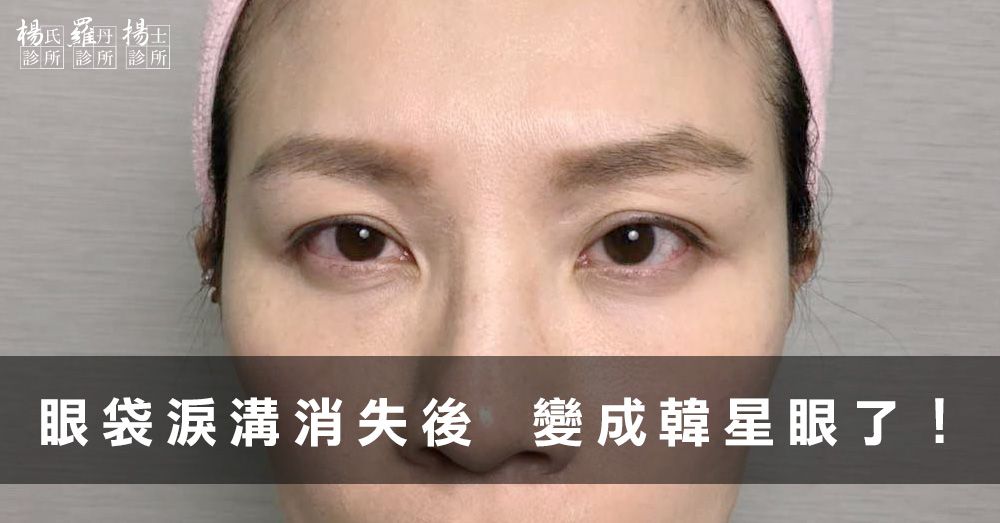 【新竹‧眼袋淚溝手術】顯老淚溝bye bye！現在的我雙眼很有神！
