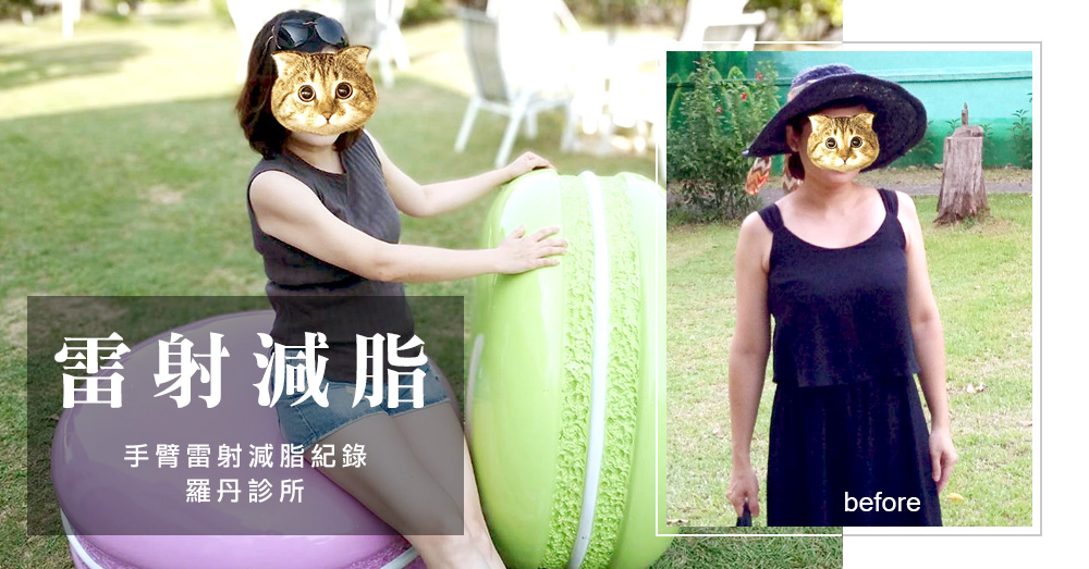 【台北‧雷射減脂瘦手臂】肉肉女的逆襲消除胖手臂！