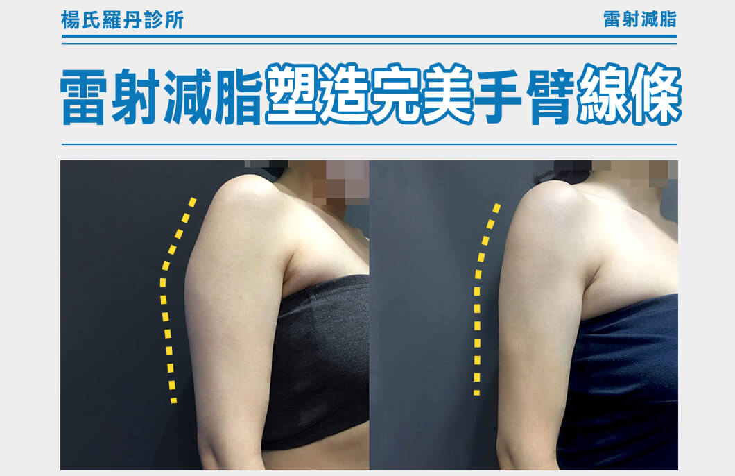 【雷射減脂】對付手臂贅肉，雷射減脂塑造完美手臂線條