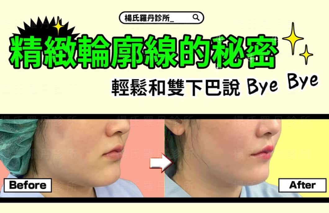 【雷射減脂】精緻輪廓線的秘密，輕鬆和雙下巴說Bye Bye
