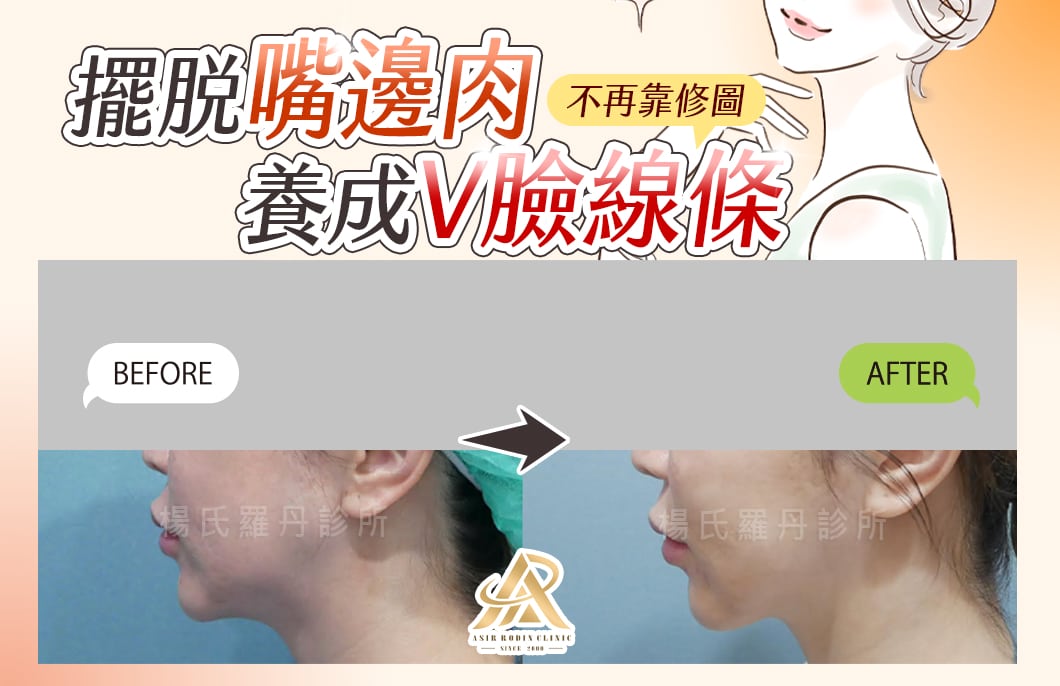 【雷射減脂】擺脫嘴邊肉陰影，養成V臉線條不再靠修圖