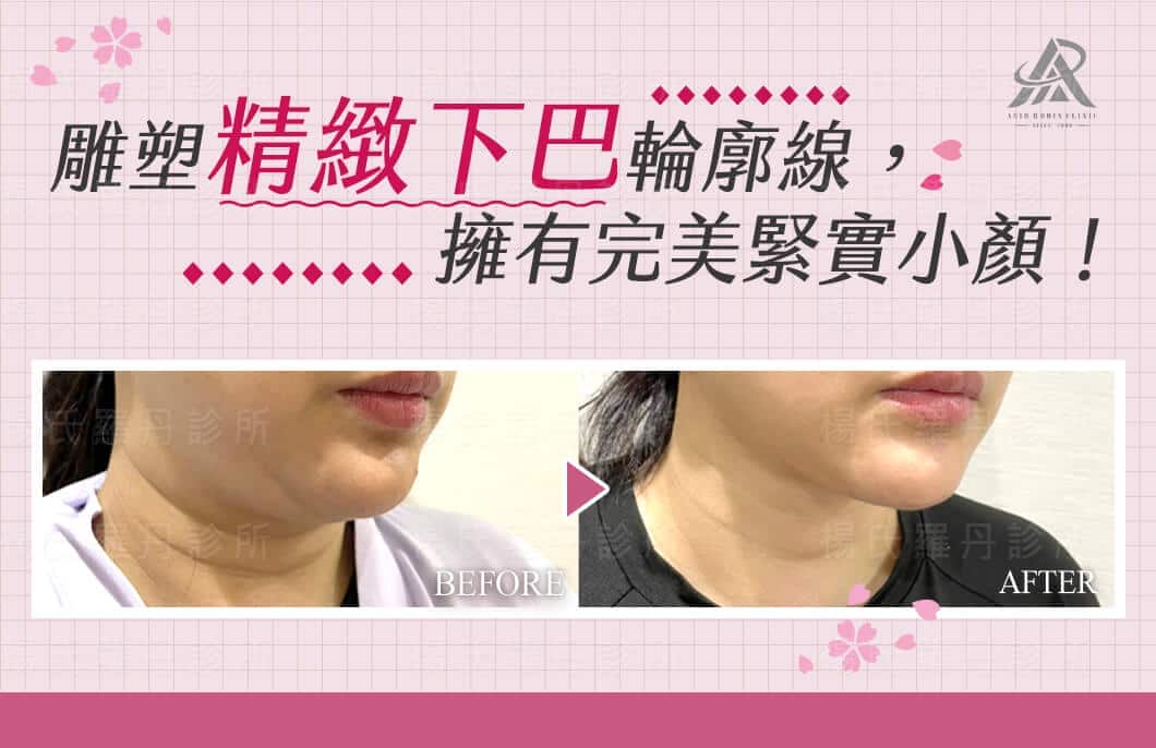 【雷射減脂】雕塑精緻下巴輪廓線，擁有完美緊實小顏！