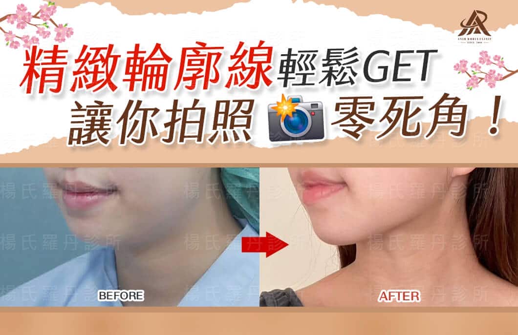 【雷射減脂】精緻輪廓線輕鬆get，讓你拍照零死角！