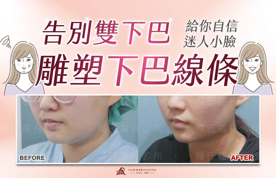 【雷射減脂】告別雙下巴，雕塑下巴線條給你自信迷人小臉