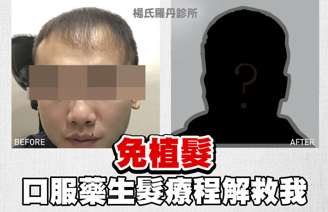 【複合式生髮】免植髮！口服藥三合一療程解救我～