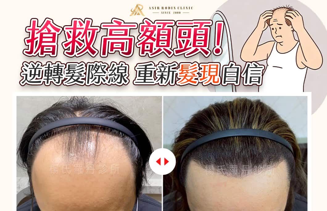 【植髮】搶救高額頭！逆轉後退髮際線，重新「髮」現自信