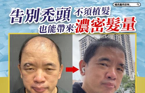【複合式泌髮】告別禿頭，不須植髮也能帶來濃密髮量！