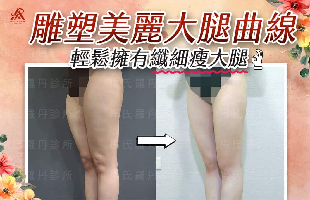 【雷射減脂】雕塑美麗大腿曲線，輕鬆擁有纖細瘦大腿！