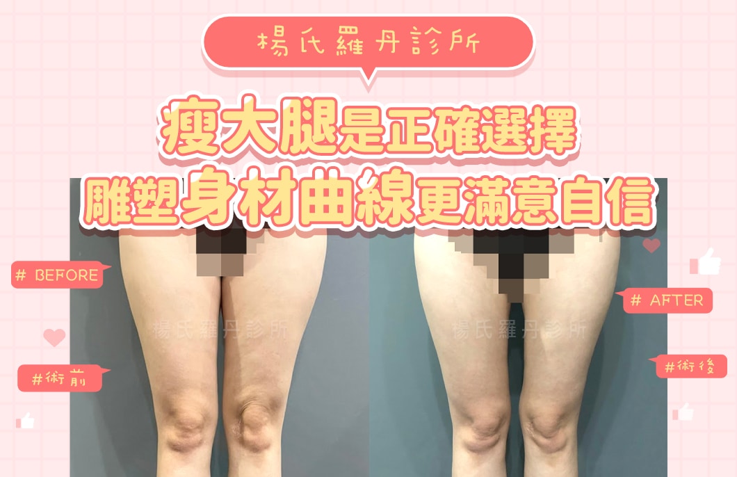 【雷射減脂】瘦大腿是正確選擇，雕塑身材曲線更滿意自信