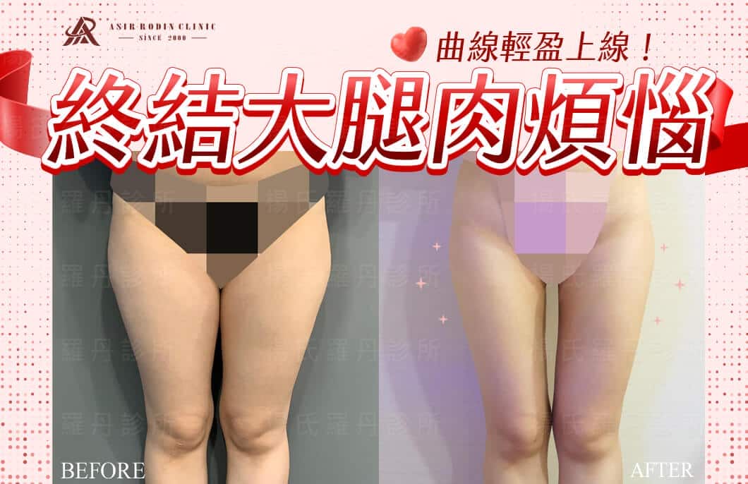 【雷射減脂】終結大腿肉煩惱，打造勻稱曲線輕盈上線！
