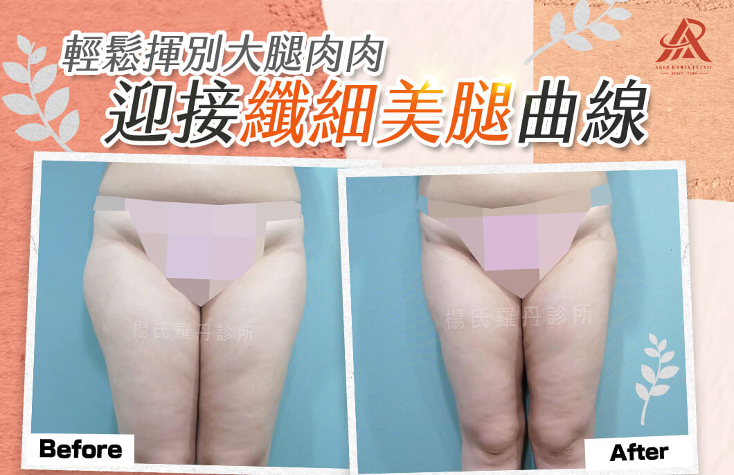 【雷射減脂】輕鬆揮別大腿肉肉，迎接夏日纖細美腿曲線