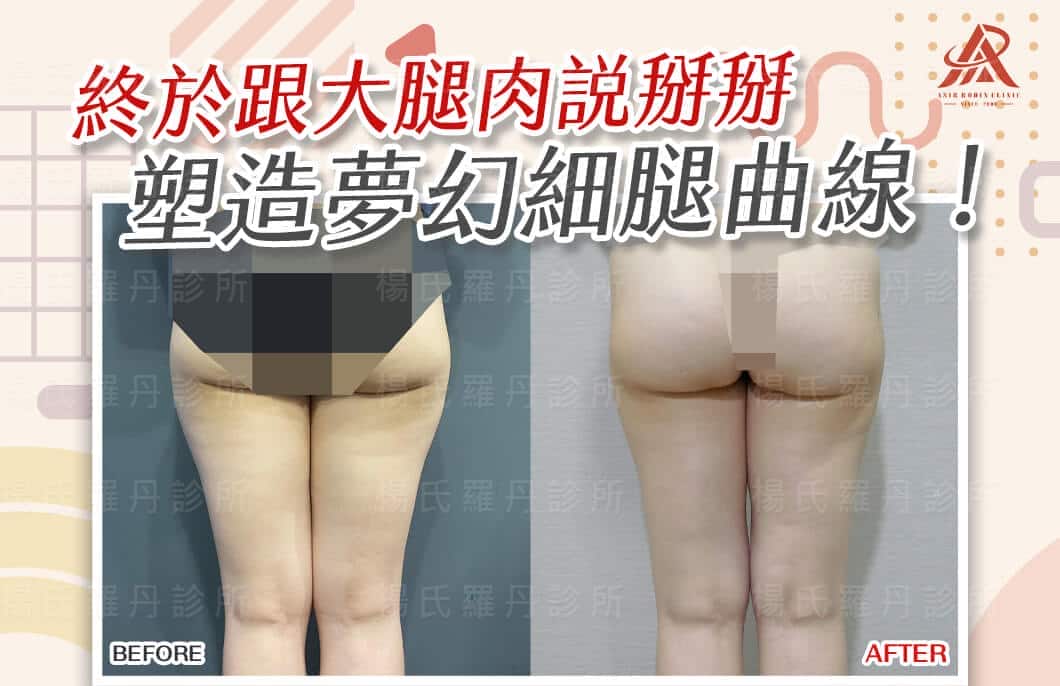 【雷射減脂】終於跟大腿肉說掰掰，塑造夢幻細腿曲線！