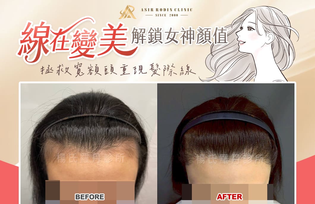 【植髮】拯救寬額頭重現髮際線，線在變美解鎖女神顏值