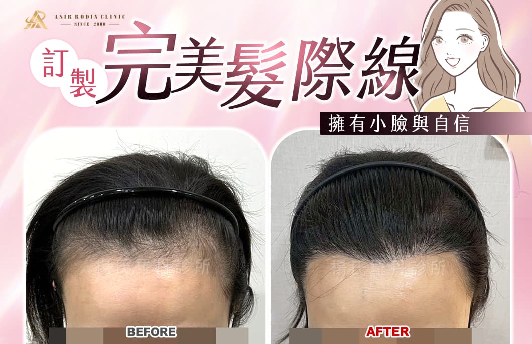 【植髮】終於敢露額頭，訂製完美髮際線，擁有小臉與自信