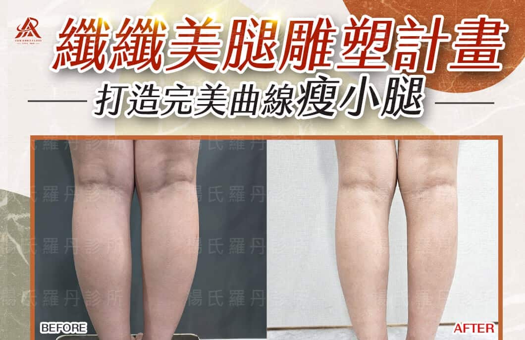【雷射減脂】纖纖美腿雕塑計畫，打造完美曲線瘦小腿！