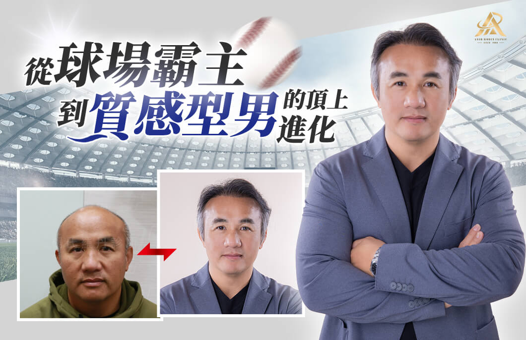 張泰山前植後泌育髮療程對比照，植髮後頭髮濃密回歸，成功重生森林王子髮量