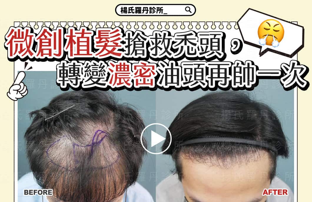 【植髮】FUE微創植髮搶救禿頭，轉變濃密油頭再帥一次