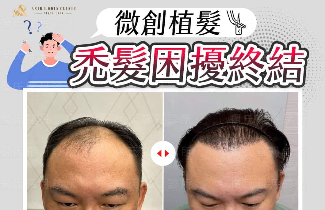 【植髮】禿髮困擾終結！微創植髮帶來自然髮際線展年輕