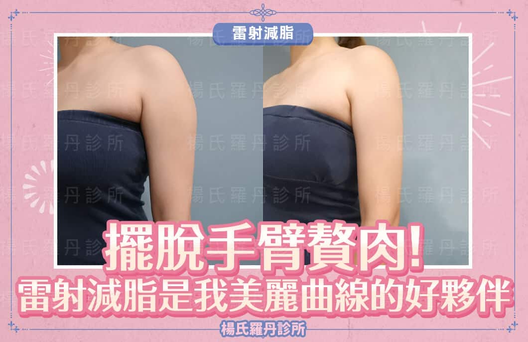 【雷射減脂】擺脫手臂贅肉!雷射減脂是我美麗曲線的好夥伴