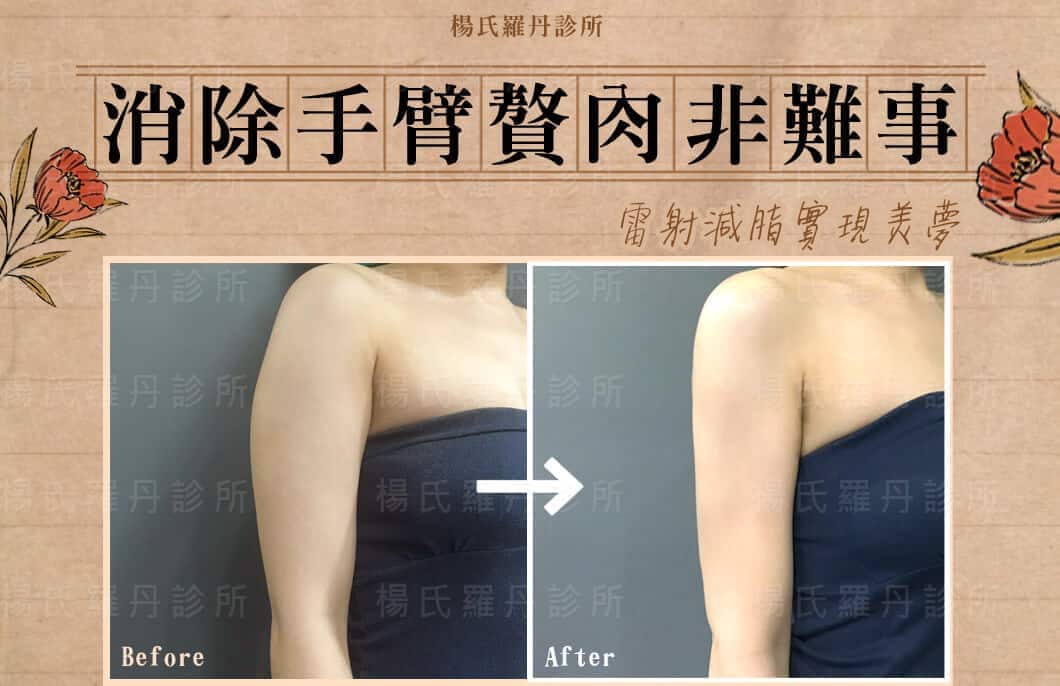 【雷射減脂】消除手臂贅肉再也非難事  雷射減脂實現美夢